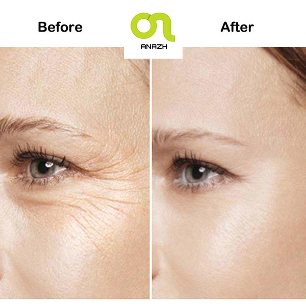 سرم آرژیرلین ضدچروک و پر کننده خطوط صورت و دور چشم 10 درصد دی اوردینری Argireline 10%-اناژ
