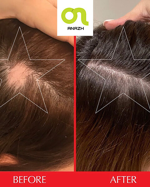 پک دو عددی کپسول تقویت مو هیرتامین اورجینال-اناژ